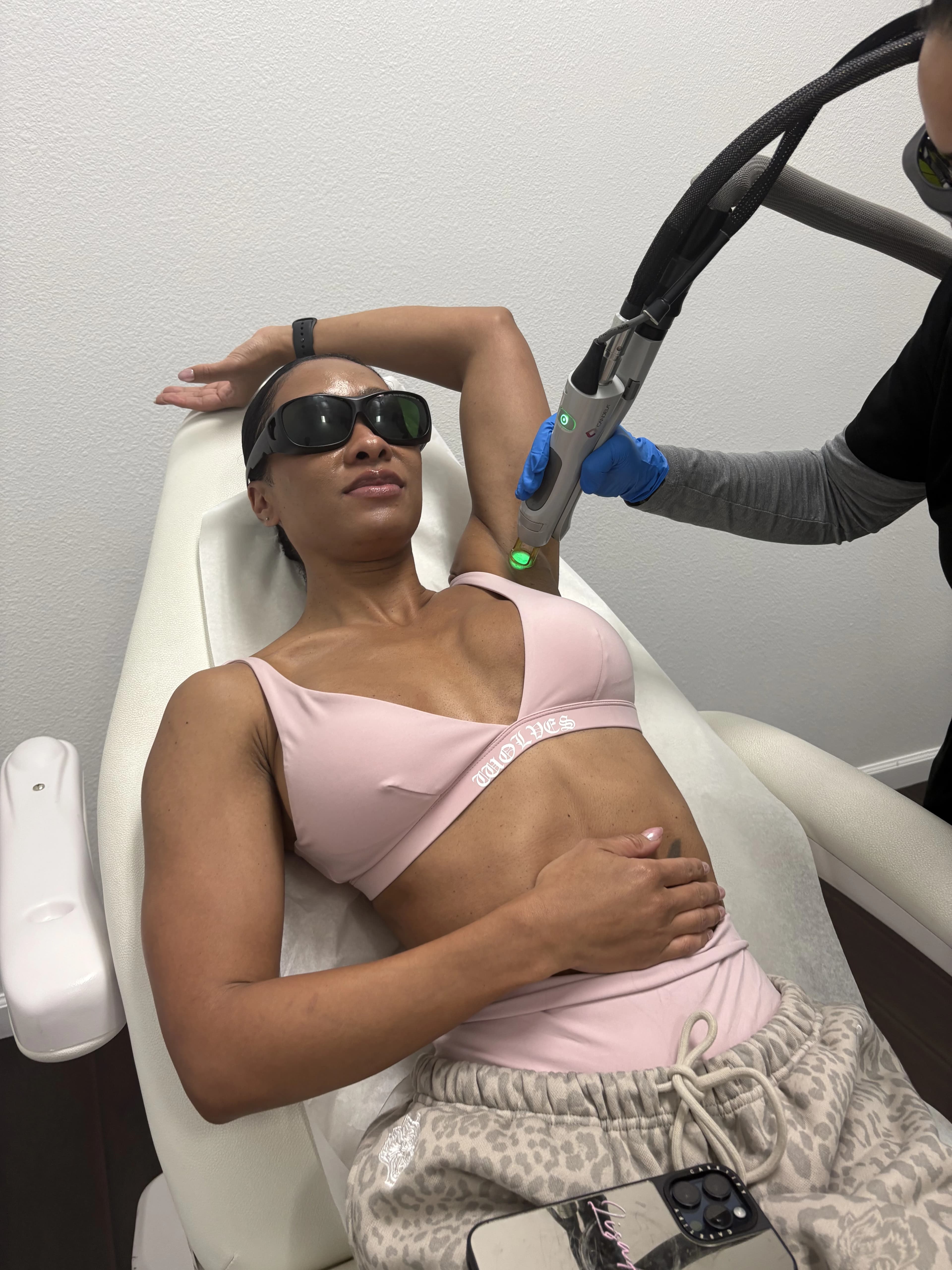 Candela handpiece treating an underarm at Spoiled Aesthetics